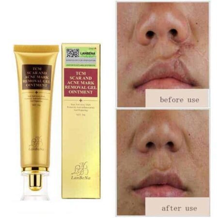 Crème anti-cicatrices et acné, lutte contre les chéloide; pommade pour le visage TCM SCARAND