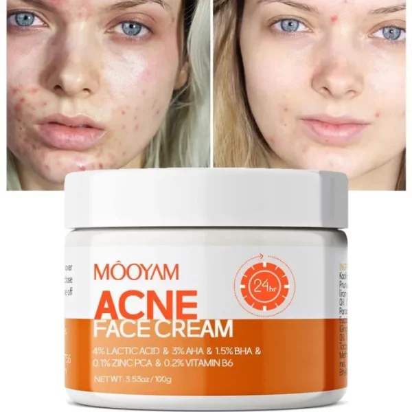 creme pour le visage de l acne mooyam anti acne