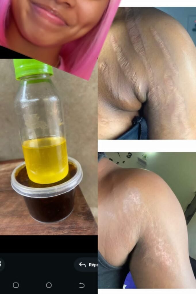 Kit anti vergeture