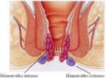 hemorroides 300x220